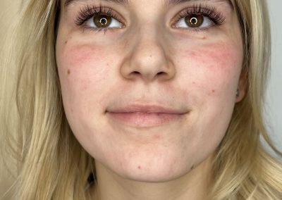 Podaljševanje trepalnic